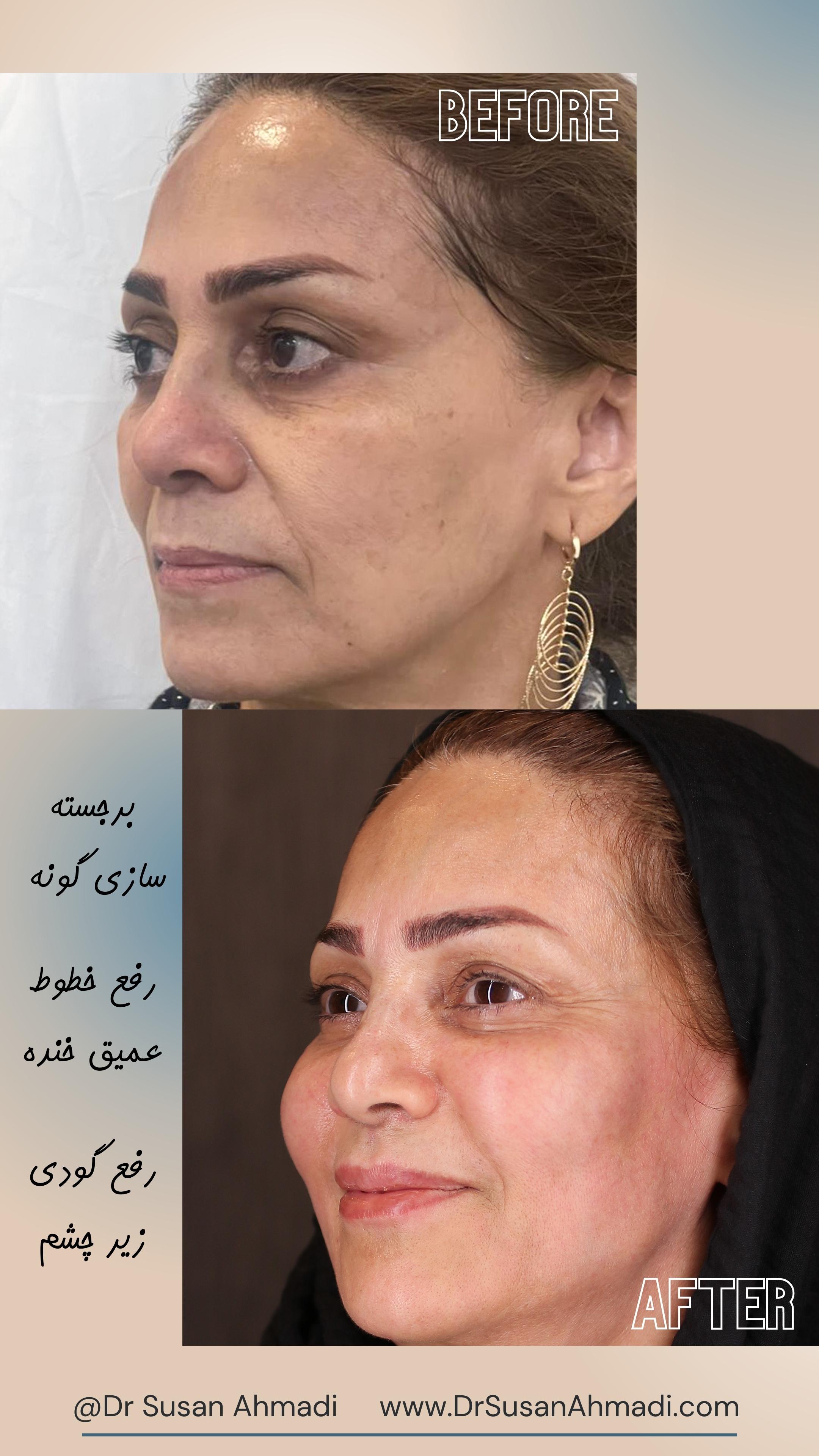 جوانسازی با تزریق چربی