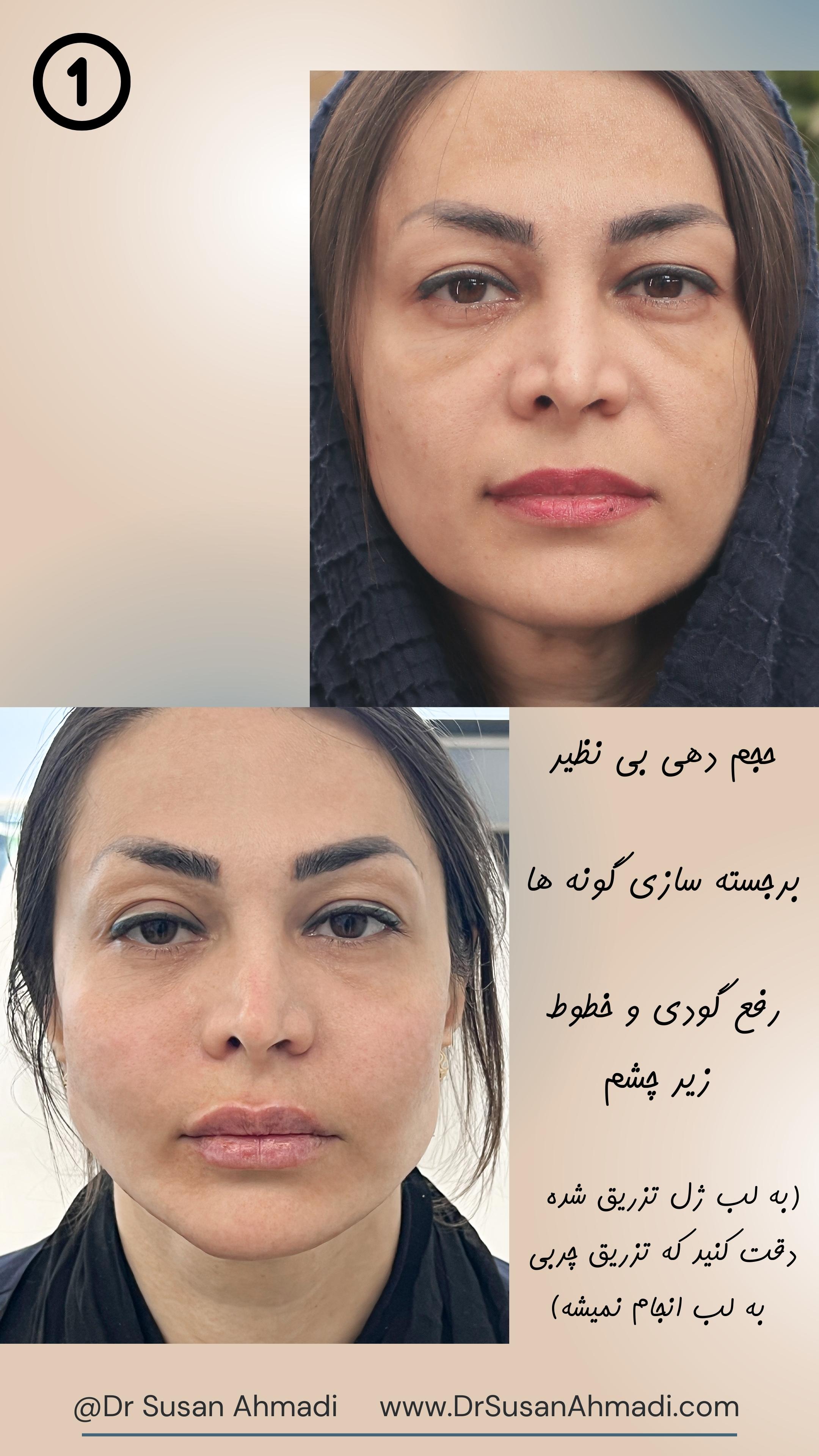تزریق چربی