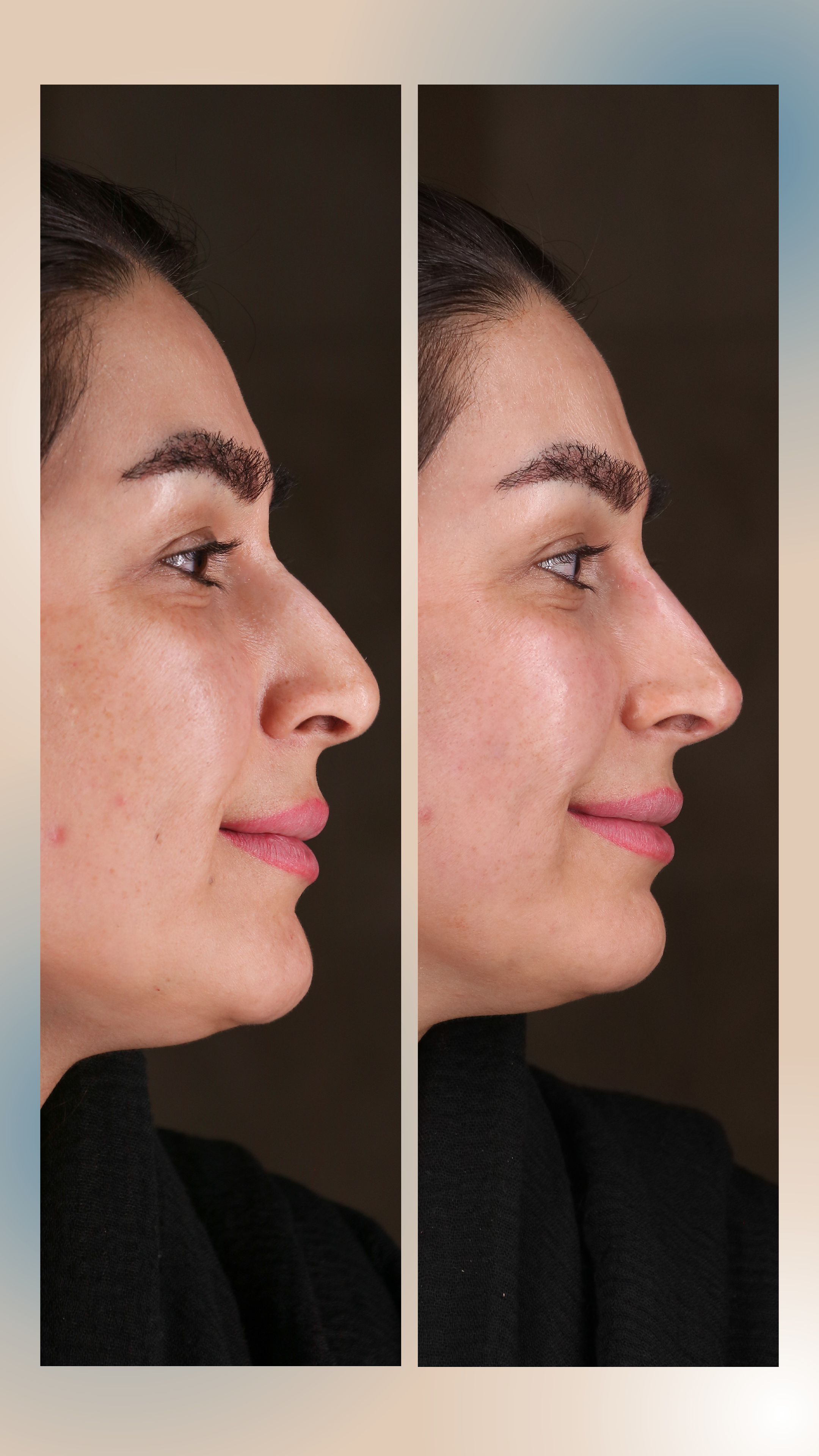 اصلاح خطوط بینی