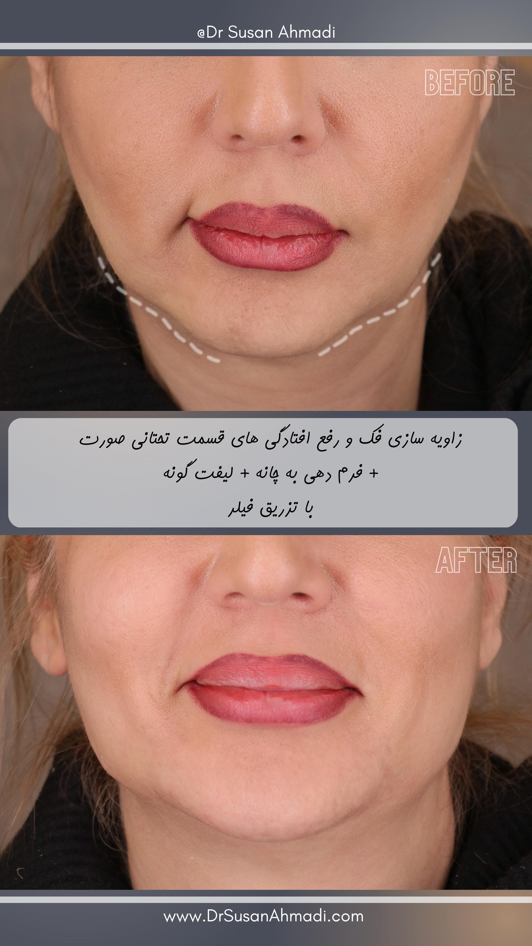 فیلر لب