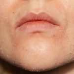 پاکسازی پوست جوش دار