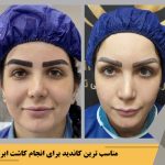 مزوتراپی ابرو در مقابل کاشت ابرو: کدام روش برای داشتن ابروهای دلخواه بهتر است؟ مقایسه با دکتر احمدی
