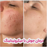 چند جلسه میکرونیدلینگ نیاز است؟