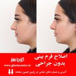 مدیکال راینوپلاستی بدون جراحی: روشی نوین برای اصلاح فرم بینی با دکتر احمدی