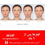 آیا اما واتسون فیلر تزریق کرده؟ بررسی حجم‌دهی صورت و روش‌های مشابه