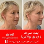 جوانسازی صورت لئوناردو دی‌کاپریو: آیا فیلر و بوتاکس استفاده کرده؟