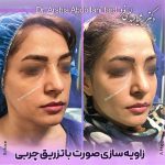 تزریق چربی طبیعی برای رفع افتادگی و زاویه سازی صورت | نمونه کار دکتر سوسن احمدی
