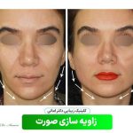 مراحل مادلینگ صورت با فیلر چگونه است؟ از مشاوره تا تزریق و مراقبت های بعد از آن | راهنمای دکتر سوسن احمدی