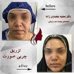 هر آنچه که می خواهید در مورد رفع عیوب پوستی با تزریق چربی بدانید + فیلم