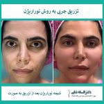 مینابرهای جوانسازی بدون تزریق