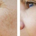 تاثییر لیزر در جوانسازی پوست، بررسی تکنیک های مورد استفاده احتمالی جولیا رابرتس