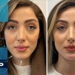 فرمدهی چانه با فیلر: راهنمای جامع برای ایجاد تعادل و زیبایی در خط چهره بدون جراحی