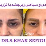 جدیدترین تکنیک های تزریق فیلر زیر چشم برای رفع تیرگی و گودی با دکتر سوسن احمدی