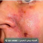 اگر فیلر نزنی پوستت چی میشه؟