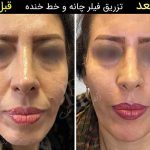 مراحل تزریق فیلر خط خنده توسط دکتر سوسن احمدی: راهنمای کامل و مراقبت های بعد از آن