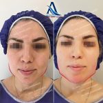 فتگرفت صورت: راهنمای کامل جوانسازی طبیعی با تزریق چربی