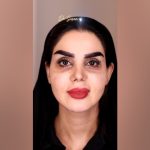 فیلم تزریق چربی طبیعی برای رفع گودی زیر چشم | دکتر سوسن احمدی