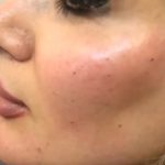 مراقبت های بعد از تزریق چربی طبیعی برای حفظ تغییر نچرال و زیبا: توصیه های دکتر سوسن احمدی