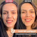 هزینه تزریق فیلر برای رفع خط خنده در کلینیک دکتر سوسن احمدی چقدر است؟