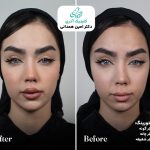 بهترین کاندید برای فتگرفت صورت: چه کسانی از جوانسازی طبیعی با تزریق چربی بهره مند می شوند؟