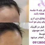 افزایش رشد مو با هیر فیلر تخصصی دکتر سوسن احمدی: مزایا، عوارض و هزینه
