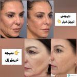 میدونی کی نباید فیلر بزنی