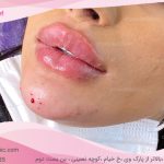 مراحل فرمدهی چانه با فیلر: آمادگی قبل از تزریق، روند انجام کار و مراقبتهای بعد از عمل