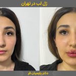 فیلر لب طبیعی یعنی چی؟