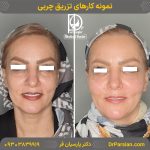 صفر تا ۱۰۰ هزینه تزریق چربی با دکتر سوسن احمدی پیر شهید: بررسی عوامل موثر بر قیمت