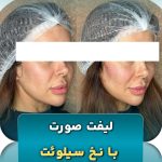 روش های غیرجراحی لیفت صورت با نخ سیلوئت نظرات دکتر سوسن تسلیمی