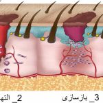 فرآیند ترمیم پوست بعد از تزریق
