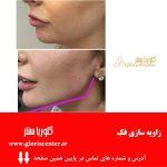 تفاوت هیالورونیک اسید طبیعی بدن و تزریقی