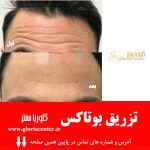 بررسی خطوط صورت لئوناردو دیکاپریو: آیا تزریق بوتاکس برای از بین بردن چروکها مناسب است؟