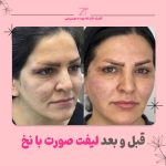 لیفت شقیقه بدون جراحی با نخ: مزایا، معایب و هزینه | مقایسه با سایر روش ها با دکتر احمدی