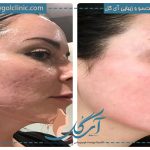 آیا رابرت دنیرو از لیزر برای جوانسازی پوست استفاده کرده است؟