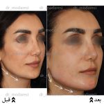 تزریق چربی به صورت برای زاویه سازی فک و گونه | دکتر مهسا کامیابی