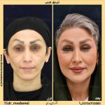 بررسی تفاوت تکنیکهای تزریق فیلر: چه زمانی تکنیک مهمتر از برند فیلر است؟ با دکتر سوسن احمدی