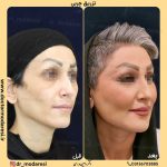 چرا تزریق چربی بهترین گزینه برای جوانسازی طبیعی پوست است؟ (دکتر سوسن احمدی)