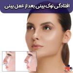 فیلر بینی برای رفع افتادگی نوک بینی بعد از عمل: آیا موثر است؟