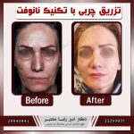 تکنیک های جدید فتگرفت: آخرین متدهای علمی جوانسازی طبیعی با تزریق چربی