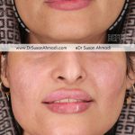 بهترین مارک فیلر برای از بین بردن خط خنده با مشاوره دکتر سوسن احمدی