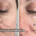 چرا زیر چشم بعضی ها گلوله میشود؟