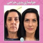 جوانسازی طبیعی پوست با فتگرفت: ماندگاری و عوارض تزریق چربی به صورت