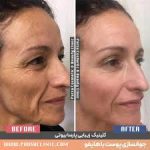 هزینه هایفوتراپی صورت و عوامل موثر بر آن + مشاهده نتایج قبل و بعد در کلینیک دکتر سوسن احمدی پیر شهید