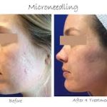 تفاوت هلی بری با سایر روش های جوانسازی پوست در چیست؟