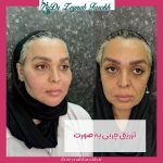 رفع عیوب صورت با چربی: آیا این روش برای شما مناسب است؟