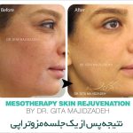 چرا مزوتراپی برای پوست های خسته ضروری است؟