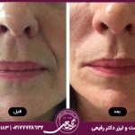 ترکیب فیلر و مزوژل برای پوست درخشان