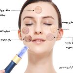 ریلز آموزشی از روند انجام میکرونیدلینگ