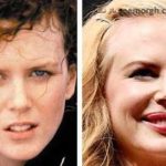 مقایسه چهره نیکول کیدمن در گذشته و حال: نقش زیبایی پزشکی
